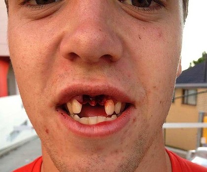 wear a mouthguard